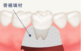 骨再生療法